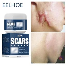 Effective Acne Scar Removal Cream Pimples Stretch Marks Surgical Burn Scar Pigmentation Corrector Smoothing Whitening Body Care