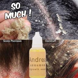 10ml Natural Anti Dandruff Essential Oils Fast Get Rid Of Anti Dandruff  Hair Loss Scalp Cleaning Dandruff Repair Health Care